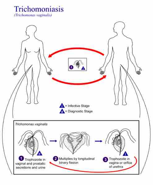 Trichomoniasis vaginalis