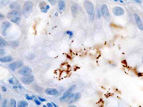 Immunohistochemical staining of H. pylori from a gastric biopsy