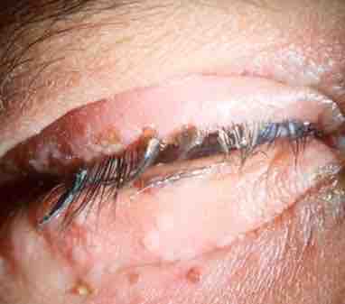 Herpes simplex blepharitis