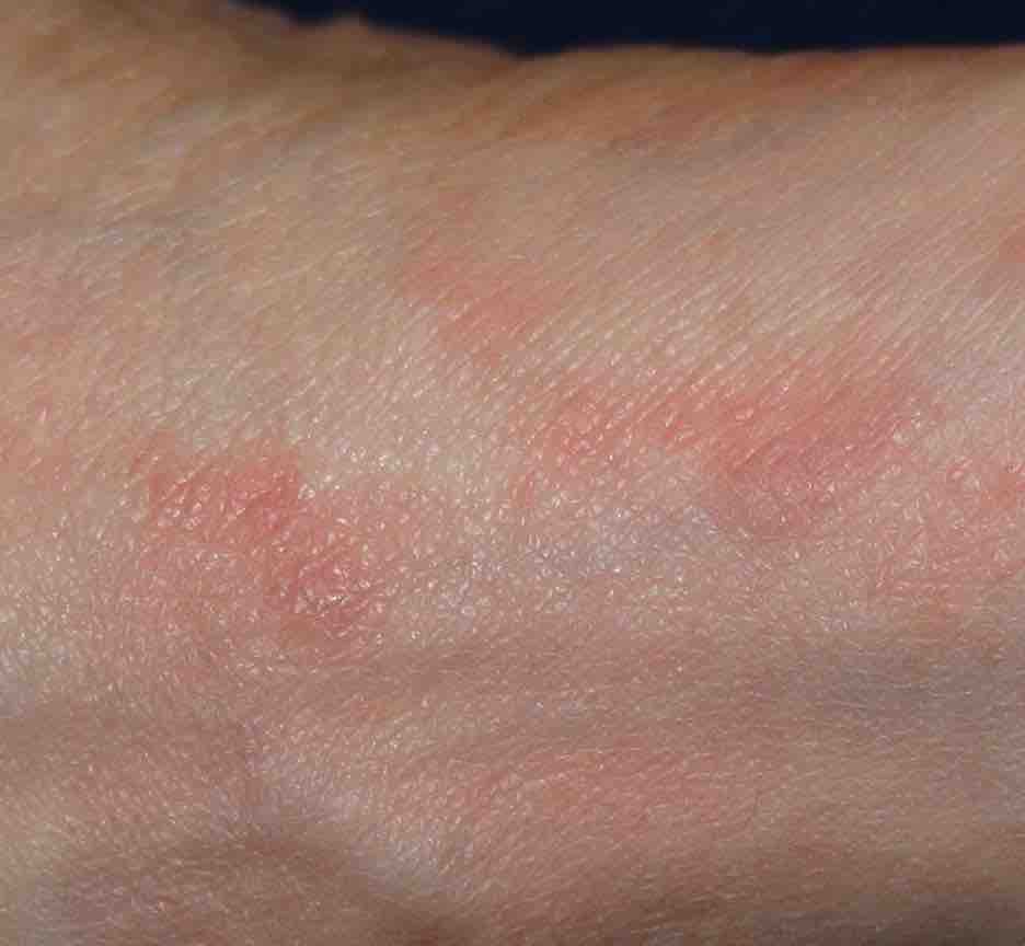 Acarodermatitis