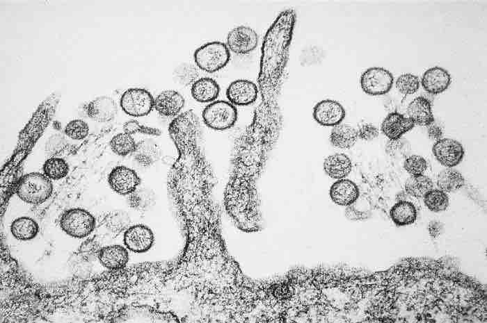 Hantavirus pulmonary syndrome