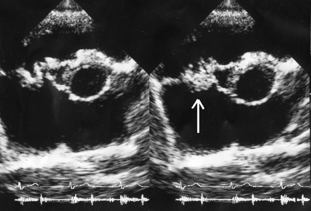 Endocarditis ultrasound