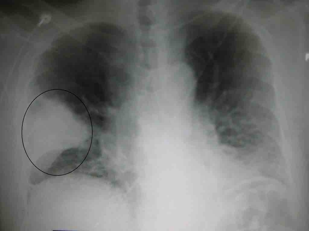 Bacterial pneumonia