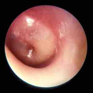 Acute Otitis Media