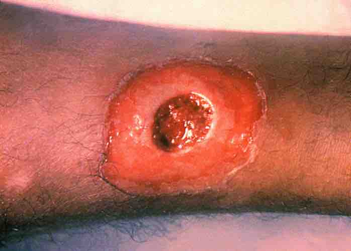 Diphtheria toxin induced lesion