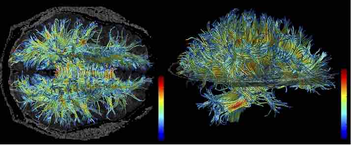 White Matter on an MRI