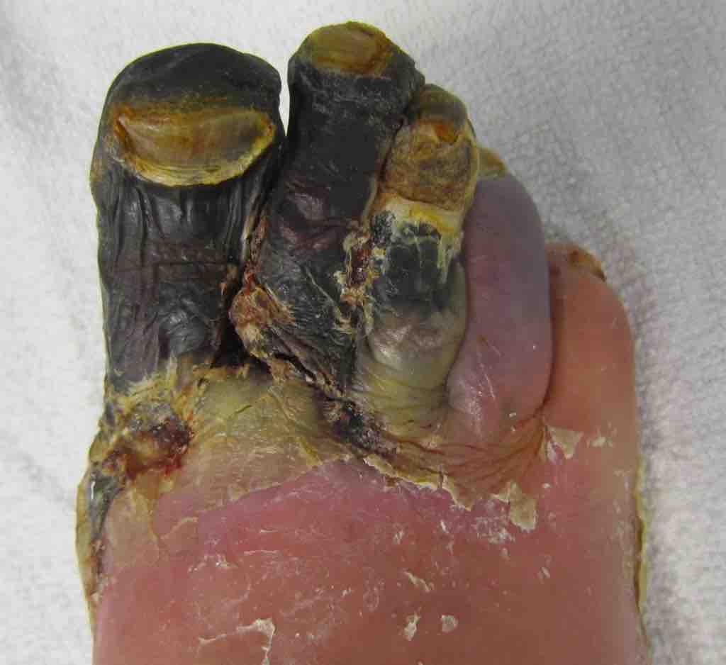 Dry Gangrene