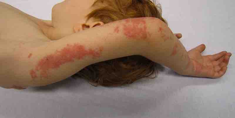 Shingles rash