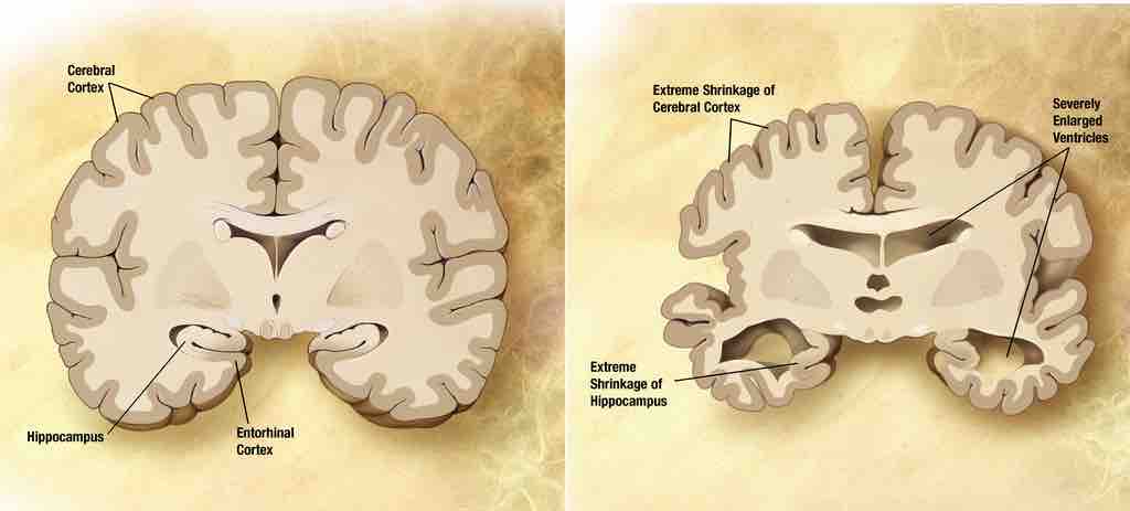 Effects of Alzheimer's Disease