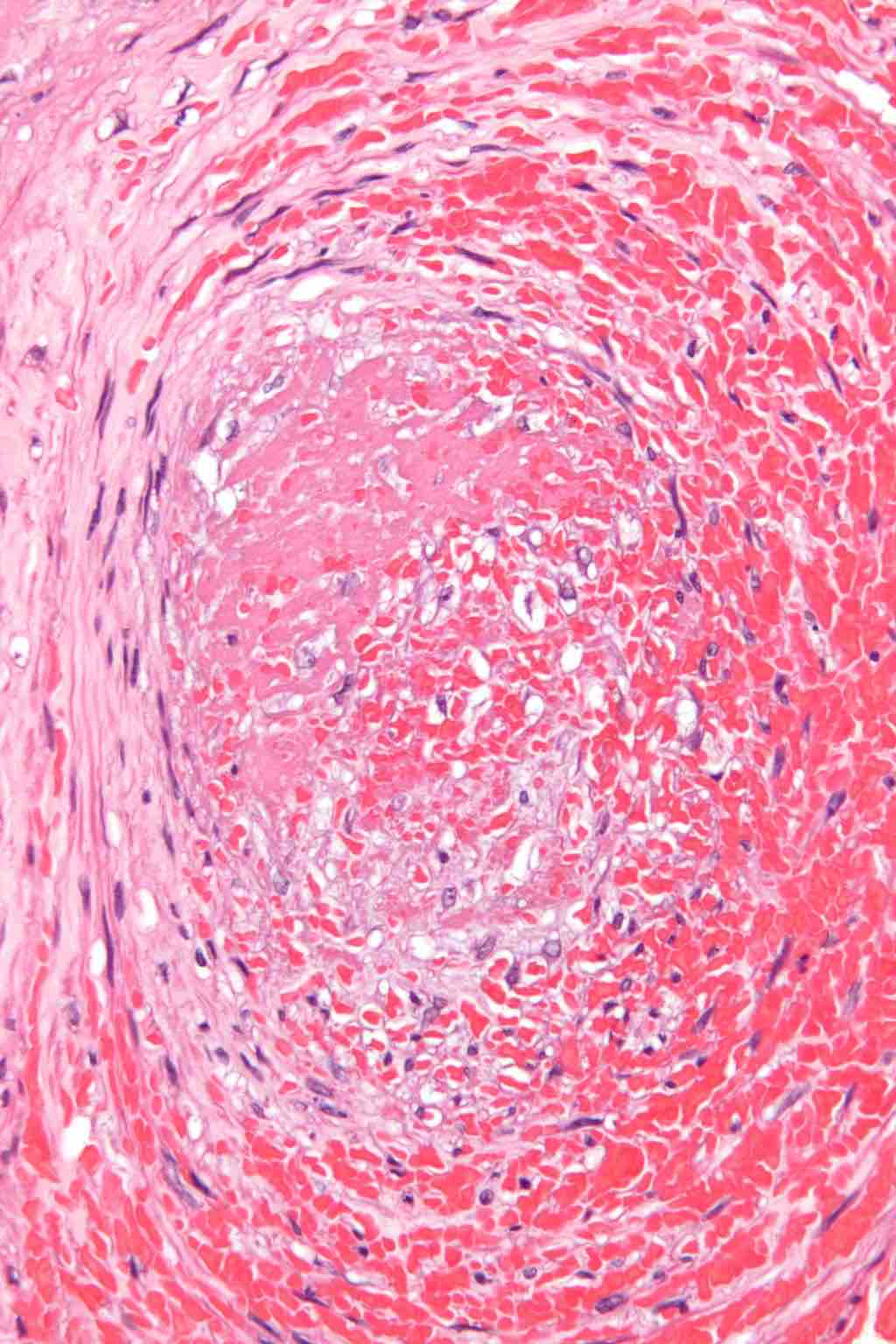 Thrombus or Blood Clot