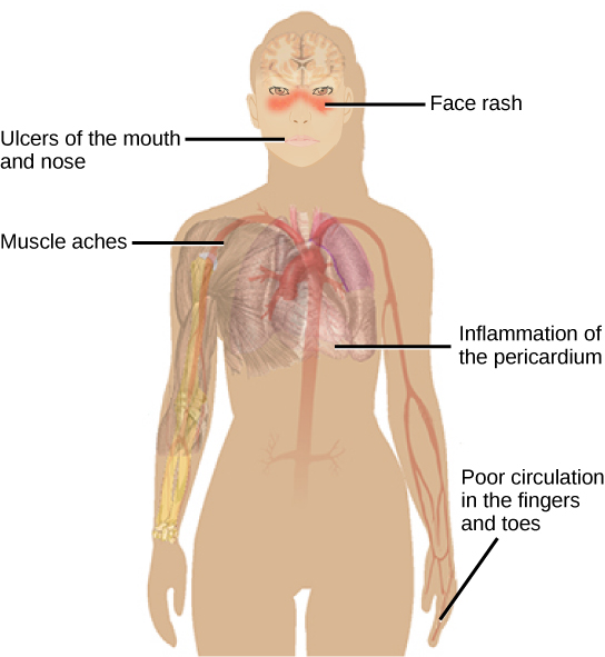 SLE and autoimmunity