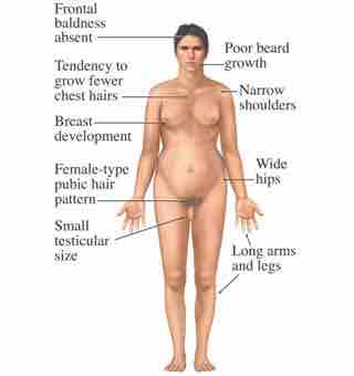 Sex Chromosome Nondisjunction