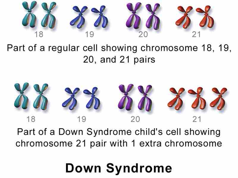 Down Syndrome