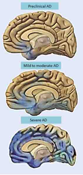 Photos depicting the progression of Alzheimer's disease