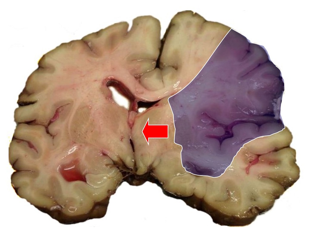 Stroke effects on the brain