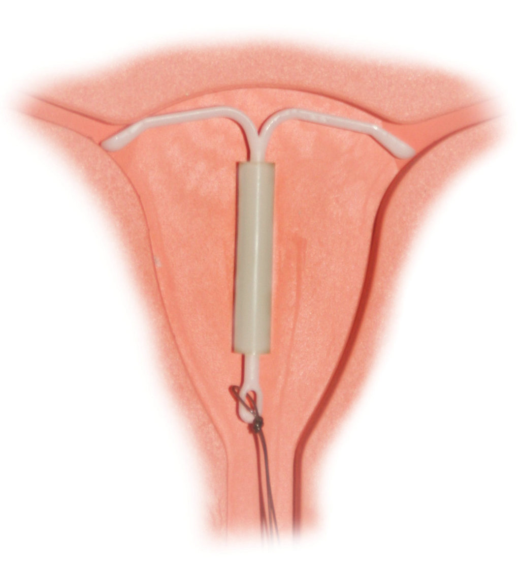 Intrauterine device