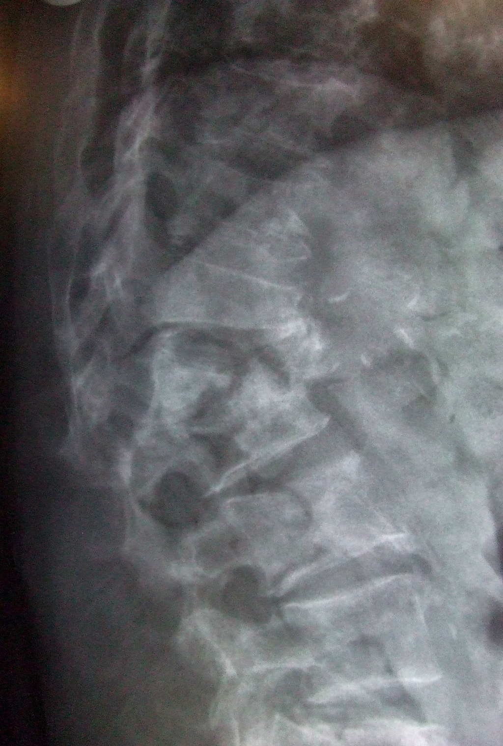 Osteoporotic Fractures