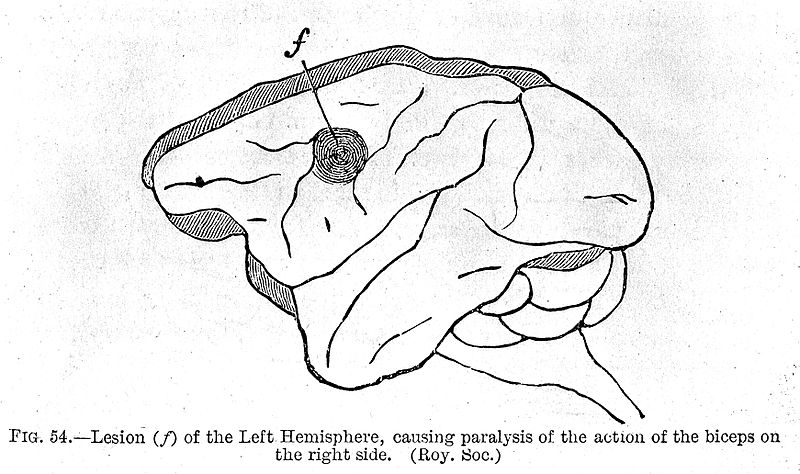 Brain lesions