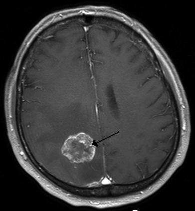 MRI of a brain lesion