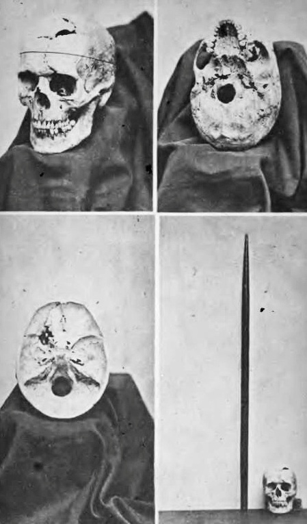 Phineas Gage's skull