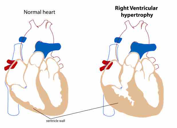 Right Ventricular Hypertrophy