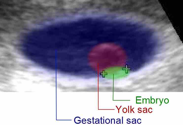 Gestational sac