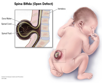 Spina
bifida