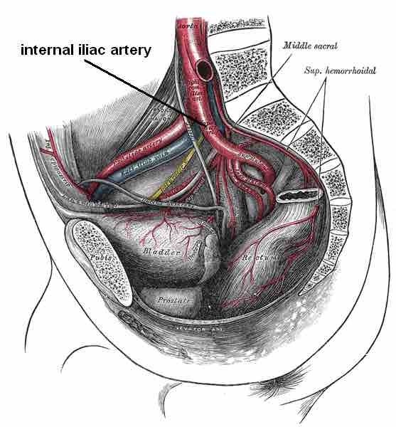 Internal Iliac Artery