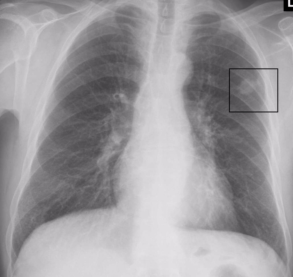 Chest x-ray showing lung cancer in the left lung

