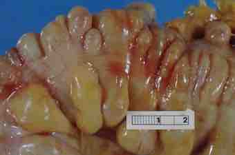 Verticula 2c sigmoid colon