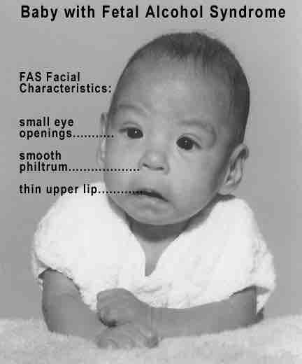 Fetal alcohol syndrome