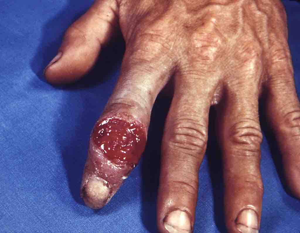 Primary Syphilitic Infection of the Finger