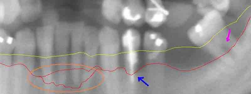 Extensive periodontal disease