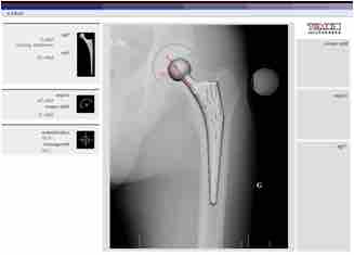 Planning Arthroplasty