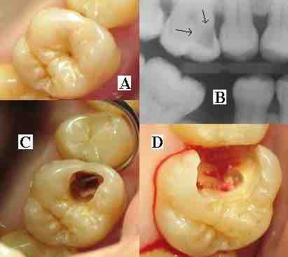 Dental caries