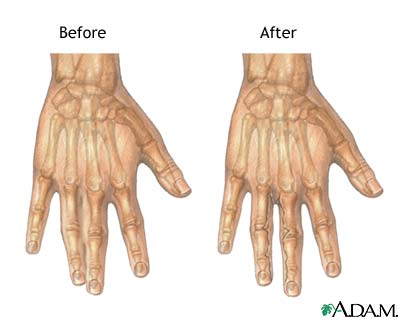Before and after webbed finger repair Before and after webbed finger repair