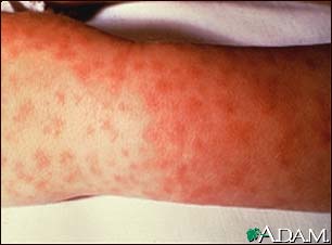 Rocky mountain spotted fever, lesions on arm Rocky mountain spotted fever, lesions on arm