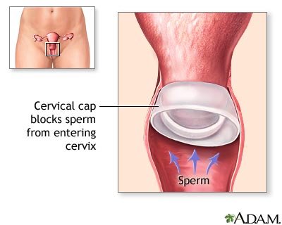 Cervical cap