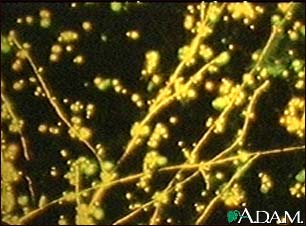 Candida, flourescent stain Candida, flourescent stain