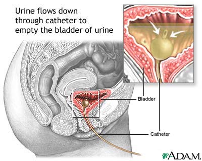 Bladder catheterization, female Bladder catheterization, female
