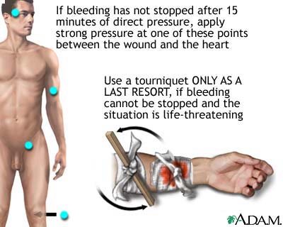 Stopping bleeding with a tourniquet Stopping bleeding with a tourniquet