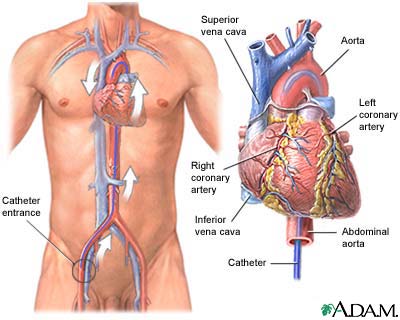 Cardiac catheterization Cardiac catheterization