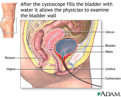 Cystoscopy Cystoscopy