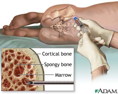 Bone marrow aspiration Bone marrow aspiration