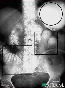 Ileus - X-ray of distended bowel and stomach