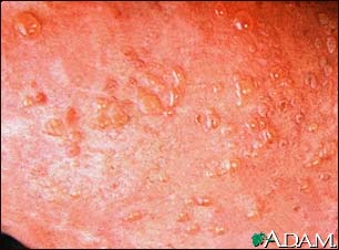Dermatitis, herpetiformis - close-up of lesion Dermatitis, herpetiformis - close-up of lesion
