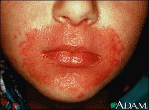 Candidiasis, cutaneous - around the mouth Candidiasis, cutaneous - around the mouth