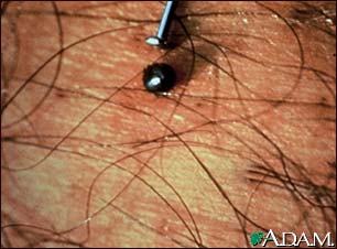 Tick, deer engorged on the skin Tick, deer engorged on the skin