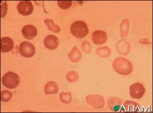 Thalassemia major