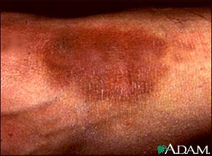 Lichen simplex chronicus on the ankle Lichen simplex chronicus on the ankle